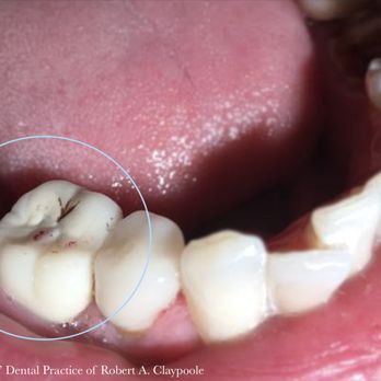 Robert A. Claypoole, DMD - Dental Crown on back molar- Jaw and gum support! - General Dentistry Near Me - Hatboro, Pennsylvania Robert A. Claypoole, DMD - Dental Crown on back molar- Jaw and gum support! - General Dentistry Near Me - Hatboro, Pennsylvania