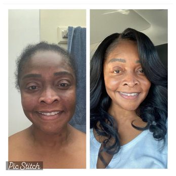 Cccorective Skincare - Before and After images. - Acne Treatment Near Me Cccorective Skincare - Before and After images. - Acne Treatment Near Me
