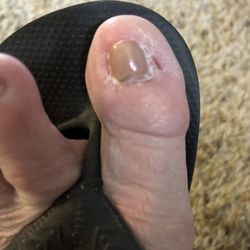 Big toenail