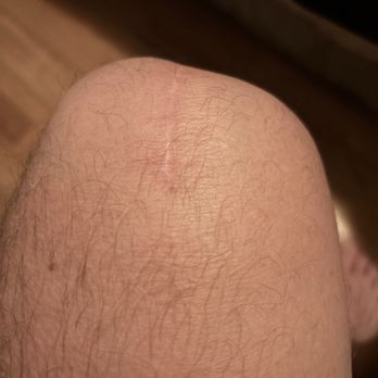 Daniel Mangiapani, MD - My knee that he messed up - Orthopedists Near Me - West Jordan, Utah Daniel Mangiapani, MD - My knee that he messed up - Orthopedists Near Me - West Jordan, Utah