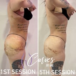Curves by Bae - Post Op Massage lipo360/bbl