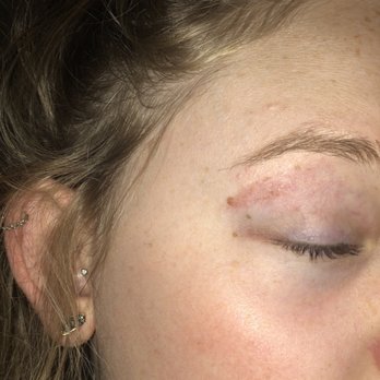 Caesars Nail Spa - This is the burn, taken 1/7/2019 - Nail Salons Near Me - Tacoma, Washington