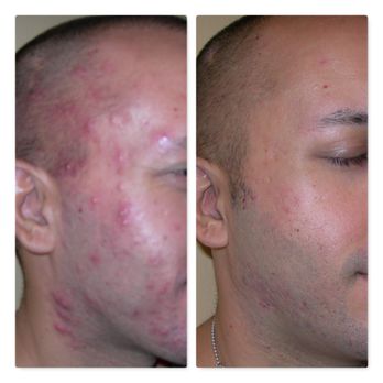 Bloom Medical Group - Ance Removal at Bloom Medical Group Whittier - Laser Hair Removal Near Me - Whittier, California Bloom Medical Group - Ance Removal at Bloom Medical Group Whittier - Laser Hair Removal Near Me - Whittier, California