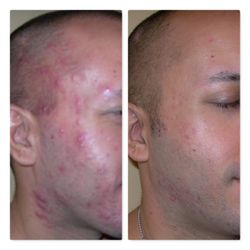 Bloom Medical Group - Ance Removal at Bloom Medical Group Whittier