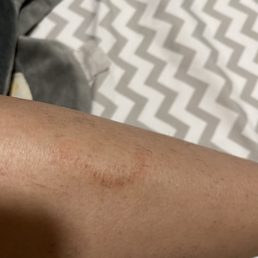 Wax burnt my skin