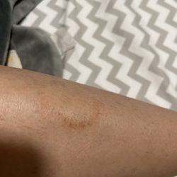 Kashish Salon - Wax burnt my skin