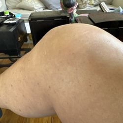Sean Rajaee, MD - Kneecap replacement, three months post surgery.