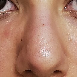 AFTER my extractions during my facial. There are a lot of blackheads left on my nose. Very disappointing. AFTER my extractions during my facial. There are a lot of blackheads left on my nose. Very disappointing.