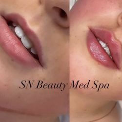 Sn Beauty Med Spa - Before and after lip fillers