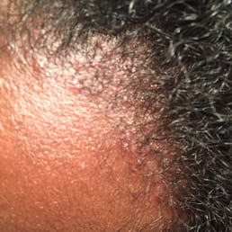Tension Alopecia Tension Alopecia