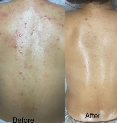 Massage Services! - Body massages and Back Acne treatments!