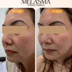Sunglow Aesthethics - Melasma treatment