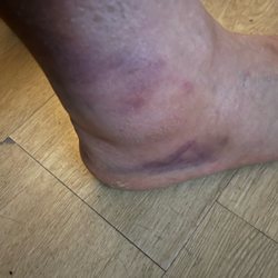 Mak's Dit Da - Sprained ankle