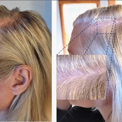 Hair Loss Consultants - 9 month follow up after treating the multiple "root" causes of this patient's scalp inflammation and hair loss