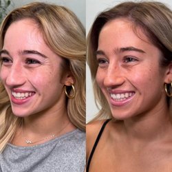 Botox with NBA Dancer