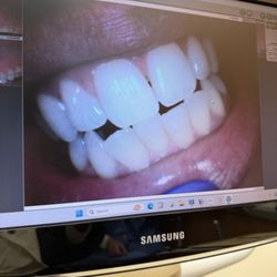 Monika Bhatia, DDS - Post cleaning