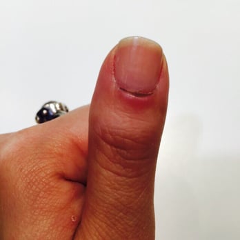 Cozy Nails - Updated picture of infected cuticle cut by Cozy Nails manicurist - you can see she cut too deep all the way across - Nail Salons Near Me - Toronto, Ontario
