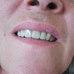 Lacey Denture Clinic - After