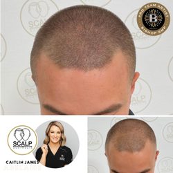 Scalp Micropigmentation Australia Adelaide - Award winning artist Emma Scalp MicroPigmentation  Adelaide