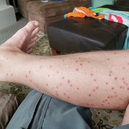 Swimmers itch, day 4 Swimmers itch, day 4