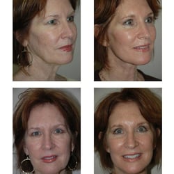 Andrew Barnett, MD - Before and after from Andrew Barnett's website