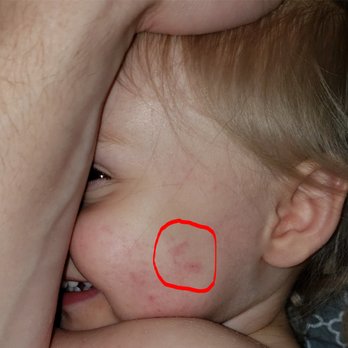FBC Learning Center - Fingerprint cut on my daughter's cheek from being choked. - Child Care & Day Care Near Me - Carl Junction, Missouri FBC Learning Center - Fingerprint cut on my daughter's cheek from being choked. - Child Care & Day Care Near Me - Carl Junction, Missouri