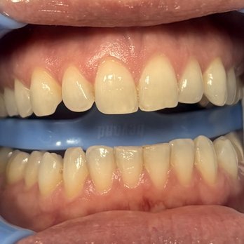 PhotoWhite - Before whitening - Teeth Whitening Near Me - Frisco, Texas PhotoWhite - Before whitening - Teeth Whitening Near Me - Frisco, Texas