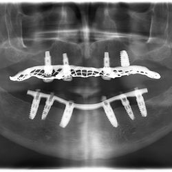 Desert Ridge Implant & Oral Surgery - Dental Implant Supported Dentures