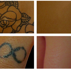Lasercare Tattoo Removal