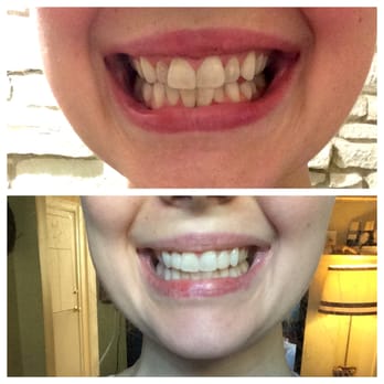 TNT Dental Care - Here is my before and after! - General Dentistry Near Me - Watertown, Massachusetts