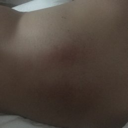 The evident bruises associated with their deep tissue massage.