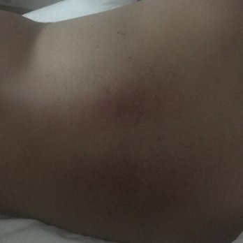 Crazy Panda Massage - The evident bruises associated with their deep tissue massage. - Massage Near Me - Murrieta, California