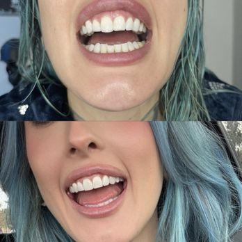 Jessamine T Sunglao, DDS - Before and after filing top front tooth, so much better! - Cosmetic Dentists Near Me - La Mesa, California Jessamine T Sunglao, DDS - Before and after filing top front tooth, so much better! - Cosmetic Dentists Near Me - La Mesa, California
