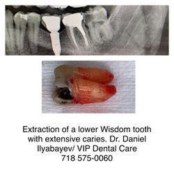 VIP Dental Care - Wisdom tooth extraction 718 575-0060