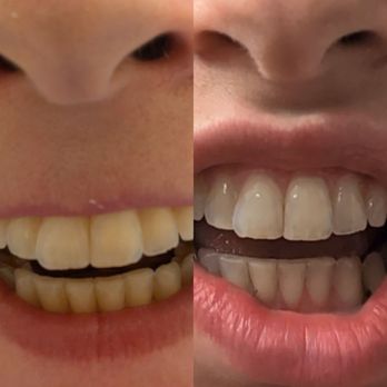 Jackson South Medical Center - My teeth before and after the dr nurse or resident chipped them - Hospitals Near Me - Miami, Florida Jackson South Medical Center - My teeth before and after the dr nurse or resident chipped them - Hospitals Near Me - Miami, Florida