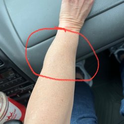 Parkwest Medical Center Imaging - Swollen from IV blown