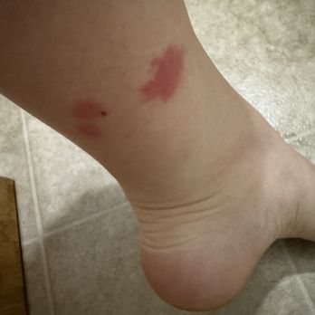 Ventura Beach Marriott - Bed bug bites - Hotels Near Me - Ventura, California Ventura Beach Marriott - Bed bug bites - Hotels Near Me - Ventura, California