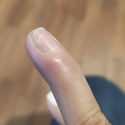 Harlem Nails - Inflammation and pus