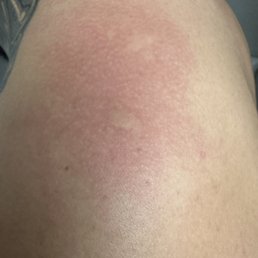 Bed bug bites Bed bug bites