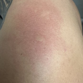 Motel 6 - Bed bug bites - Hotels Near Me - Turlock, California Motel 6 - Bed bug bites - Hotels Near Me - Turlock, California