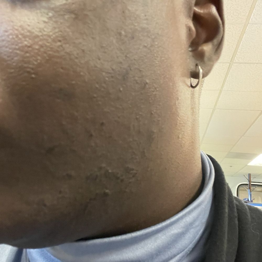 Ideal Image Vancouver - Cheek, Chin and Neck Burns post procedure - Laser Hair Removal Near Me - Vancouver, Washington Ideal Image Vancouver - Cheek, Chin and Neck Burns post procedure - Laser Hair Removal Near Me - Vancouver, Washington