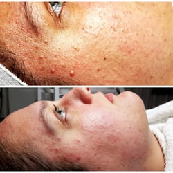 The Skin Klinic - After 1 treatment