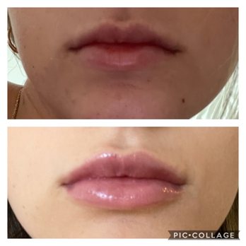 John Diaz, MD - Top- previous filler that has dissolved naturally Bottom- newly injected filler (still swollen in pic) - Cosmetic Surgeons Near Me - Beverly Hills, California