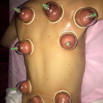 Infinity Wellness Bodywork - Cupping therapy. As you can see cups on right side is fuller- color is darker due to toxin & stagnation of blood. - Reflexology Near Me - Forest Hills, New York Infinity Wellness Bodywork - Cupping therapy. As you can see cups on right side is fuller- color is darker due to toxin & stagnation of blood. - Reflexology Near Me - Forest Hills, New York