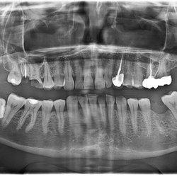 Cedar Park Dental Wellness - After wisdom tooth was removed on the right side of picture