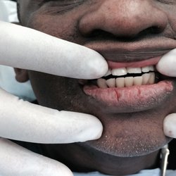 Comprehensive Dental Care - AFTER PARTIAL DENTURES 7