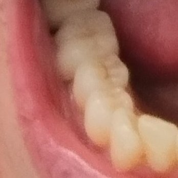 Dentologie - Belmont - My beautiful ..perfect BRIDGE REPLACEMENT..FEELS GREAT AND LOOKS GREAT. - General Dentistry Near Me - Chicago, Illinois Dentologie - Belmont - My beautiful ..perfect BRIDGE REPLACEMENT..FEELS GREAT AND LOOKS GREAT. - General Dentistry Near Me - Chicago, Illinois