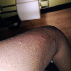 Econo Lodge - BED BUG BITES
