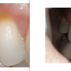 James Oh, DDS - Pinhole Gum Lift Procedure