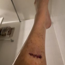 Emergency Department at St. Joseph's Hospital and Medical Center - Perfect stitches on a 3" laceration caused initially by a cat and then physics.  This is day five while dressing it according to post ER.